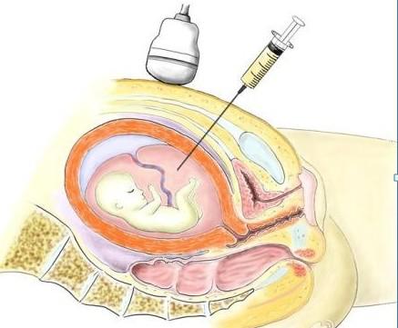孕期须知:羊水穿刺存在哪些风险