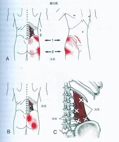 腰背痛首要原因——腰方肌