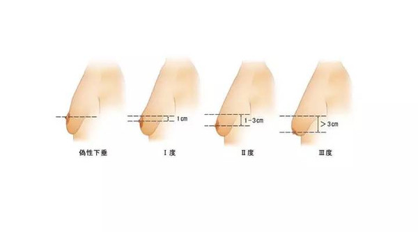 《北上广不相信眼泪》引乳房下垂矫正热议