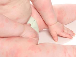 婴儿海鲜过敏症状_榕未满月婴儿湿疹发作7天被收治ICU由过敏引起