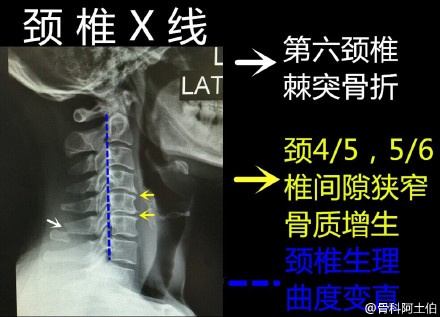 【骨科知识】颈椎x线和颈椎磁共振