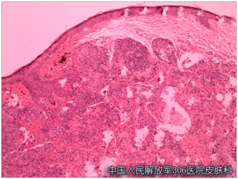 皮肤镜早期无创发现皮肤恶性肿瘤