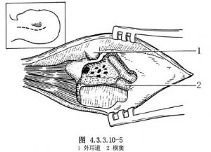 颈静脉孔区肿瘤切除术