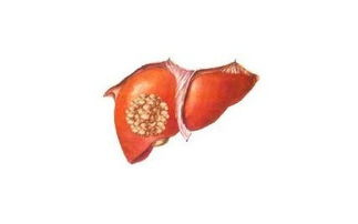 肝癌预防：怎么预防肝硬化和肝癌