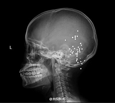 男子私改射钉枪走火 妻子头部中36颗