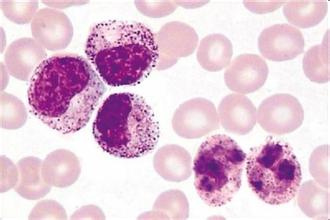 慢性粒细胞白血病的三个时期