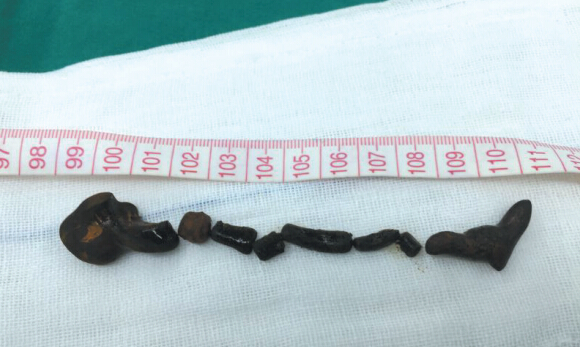 10厘米蛔虫钻入老人胆管 整条虫变成石头(图)