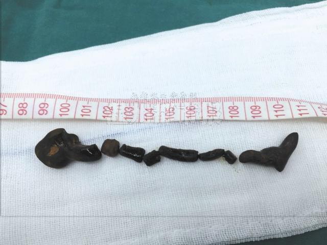 医生从患者胆管内取出的蛔虫形结石长达11厘米。 院方供图