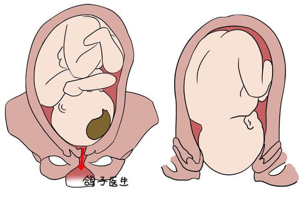 胎宝宝也在改变自己的位置以备出生,当胎儿下降到盆骨且胎位正的话