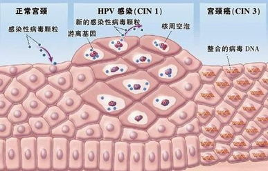 hpv不同亚型感染与宫颈病变的关系