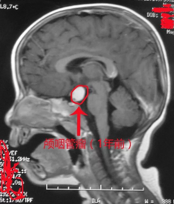3岁男童患颅咽管瘤,在我院成功切除
