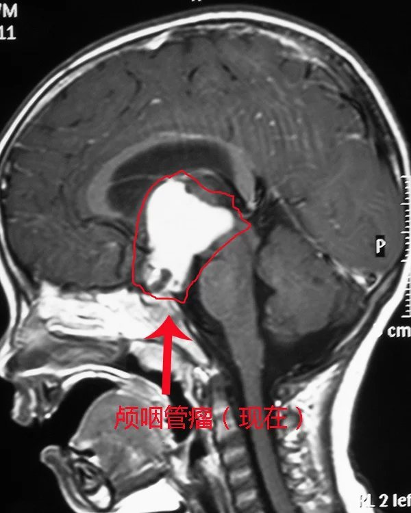 3岁男童患颅咽管瘤,在我院成功切除