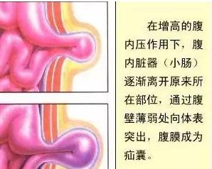 小儿推拿治疗疝气,实战案例