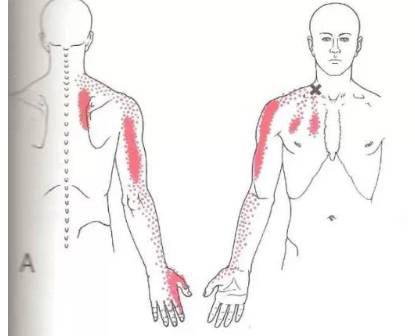 能引起肩胛骨内侧缘疼痛的十块肌肉