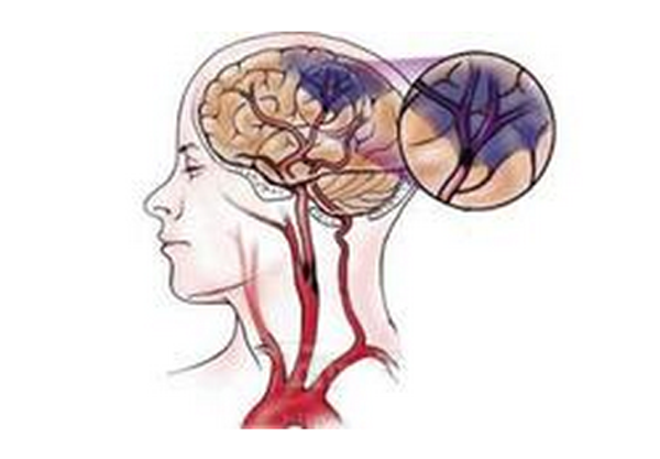 防治脑血管病 坚持一个中心,两个基本点
