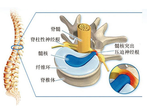 专家:关于腰椎间盘突出的几个误解