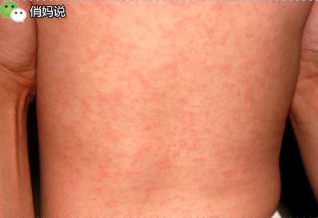 诊断时切记是高烧持续3天以上退热后随即出现的红疹子,也就是"热退疹