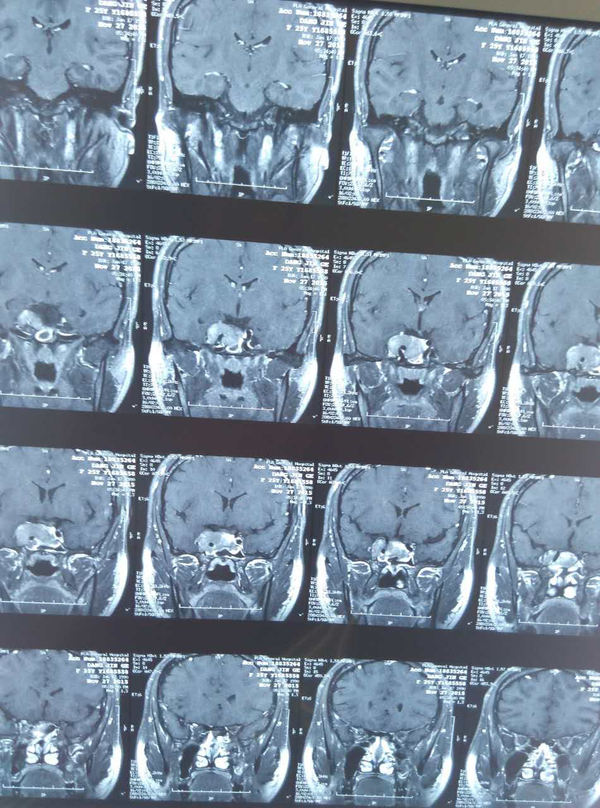 贾主任结合患者影像学资料发现小美的垂体瘤再次复发,建议可考虑再次