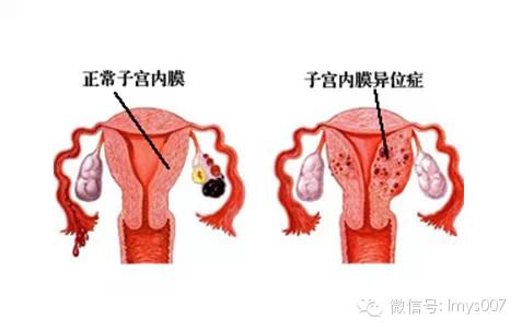 痛经隐情2:子宫内膜异位症