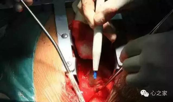 实录心脏外科瓣膜换瓣手术(重口味胆小