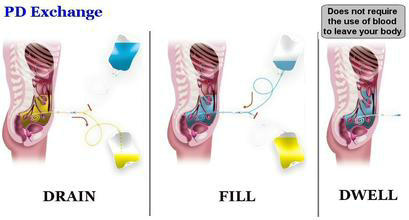 居家治疗肾衰的简易腹膜透析