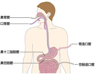 只有当患者出现对鼻胃喂养不耐受时,才建议使用鼻肠管
