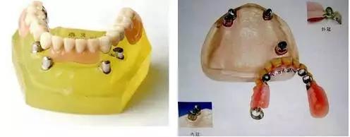 2,mk1精密附着体