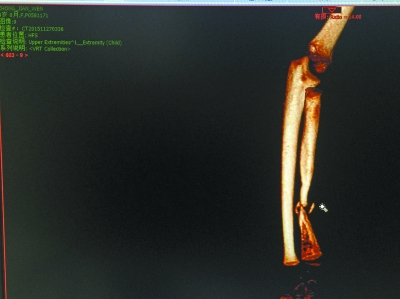 5岁女童骨折半年没长好 拍片发现少一截骨头