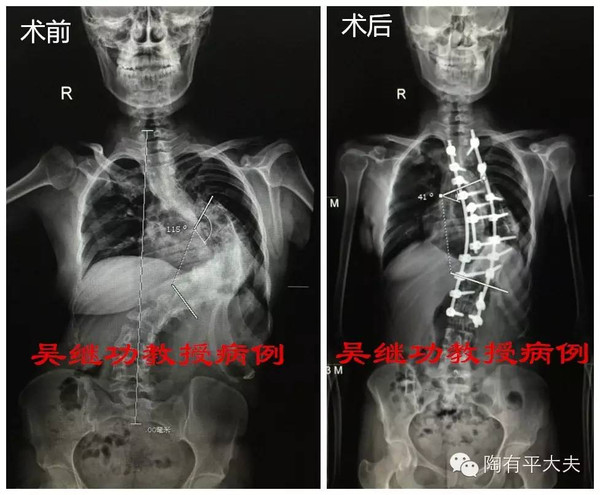 术前全脊柱三维ct:重度脊柱畸形.