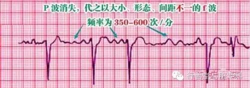 [行善堂答疑]看心电图秒懂早搏,房颤,室上速,窦