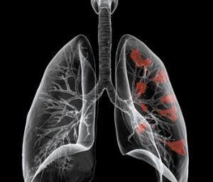 怎样判断肺部肿瘤是良性还是恶性?