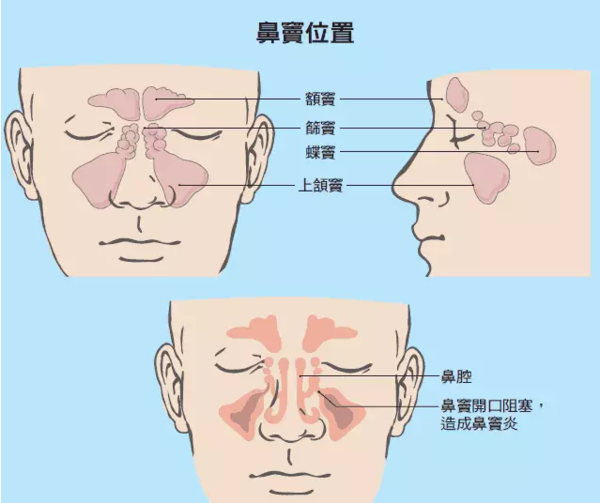 知道你得鼻炎了吗?鼻炎的症状描述