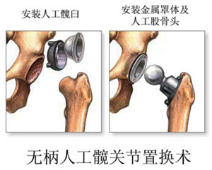 老年人股骨颈骨折:股骨头置换术效果好