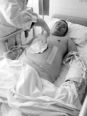 男子遇车祸肝破裂 缝上后因腹腔胀气多次撑开伤口