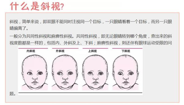 斜视会害了宝宝妈妈们必看常识