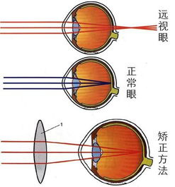 眼睛保健方法-帮助近视眼摘掉眼镜,降低眼镜度数