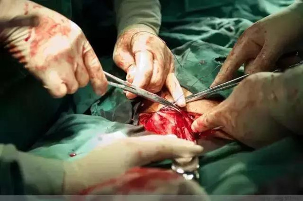 100张剖腹产过程照片,女人真的太伟大了!