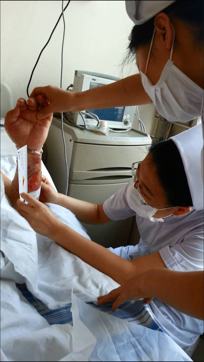 脑梗患者意外烫伤后,多家医院不予收治,神经内科护士精心护理,效果