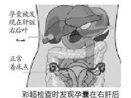 湖南孕妇宝宝怀在肝脏上 过去60年全球仅报道22例