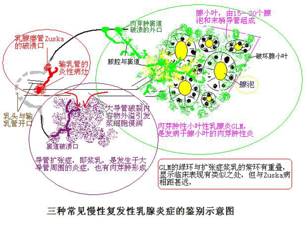 三种常见慢性复发性乳腺炎症的鉴别