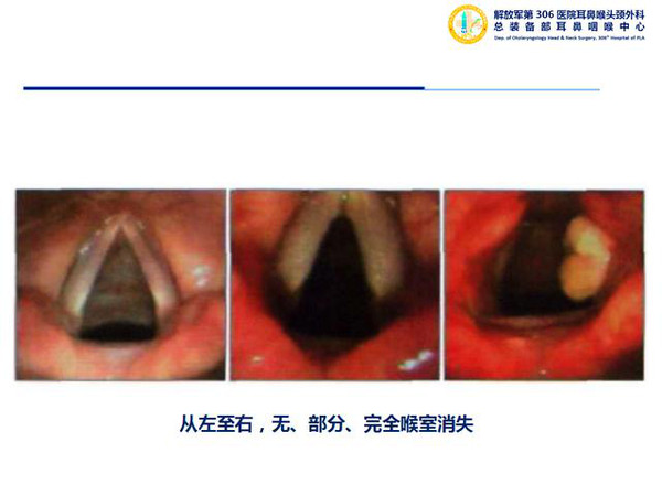 咽喉反流与上呼吸道疾病