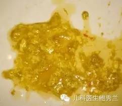 每天大便5-10次,含有较多未消化的奶块,一般无粘液,表示消化不良,多