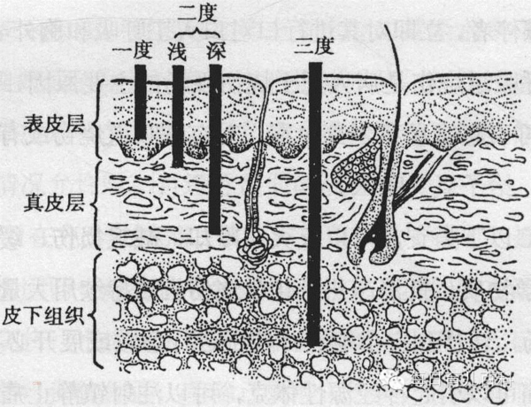 宝宝烫伤发红怎么办