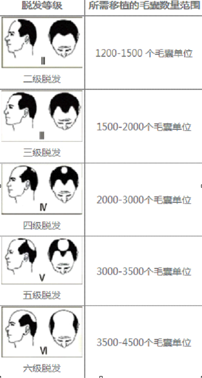 不可不知的植发费用计算公式!