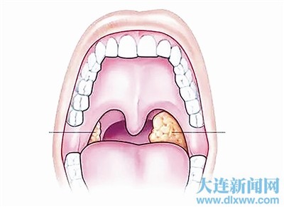 扁桃体发炎传染