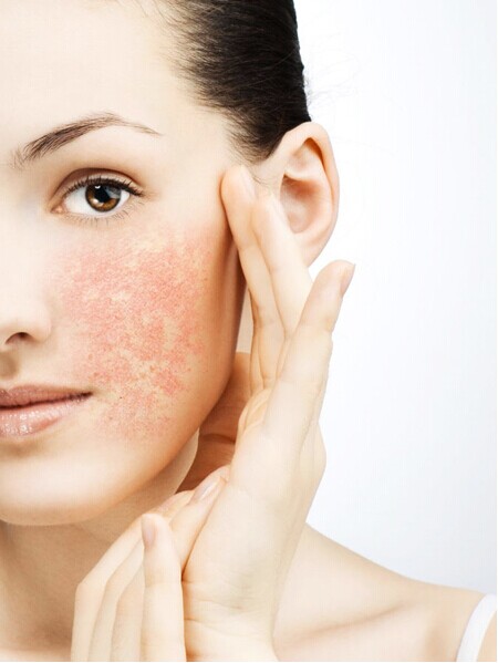 什么是敏感肌肤,脸上过敏发红发痒怎么办 ?