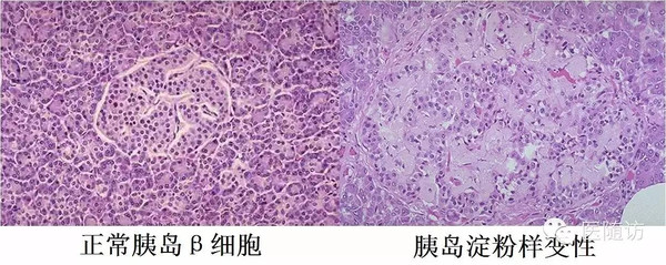 【糖尿病进阶】哪些因素导致了胰岛素分泌减少?