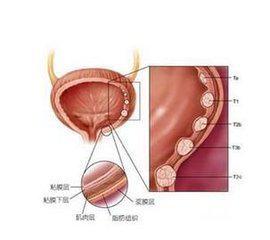 膀胱癌开放手术和经尿道膀胱肿瘤电切治疗临床分析