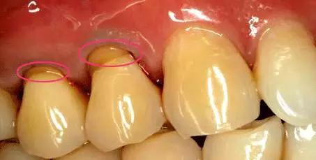 不同材料修复牙楔状缺损的疗效分析