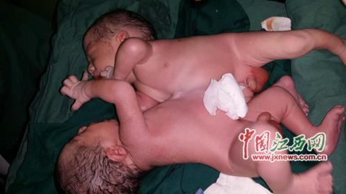 18岁孕妇首次分娩诞下连体双胞胎男婴(图)